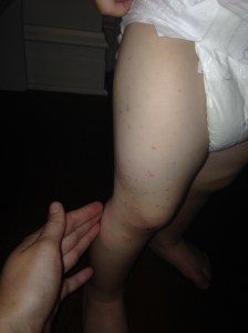 July 9, 2015 impetigo