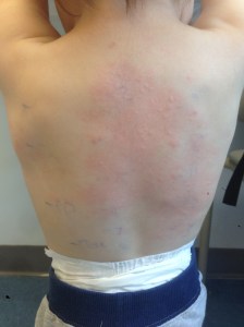 Reaction after a tiny needle prick of his more mild allergens. We forgot to wipe down his back, and this is what happened as we were leaving the dr's office.